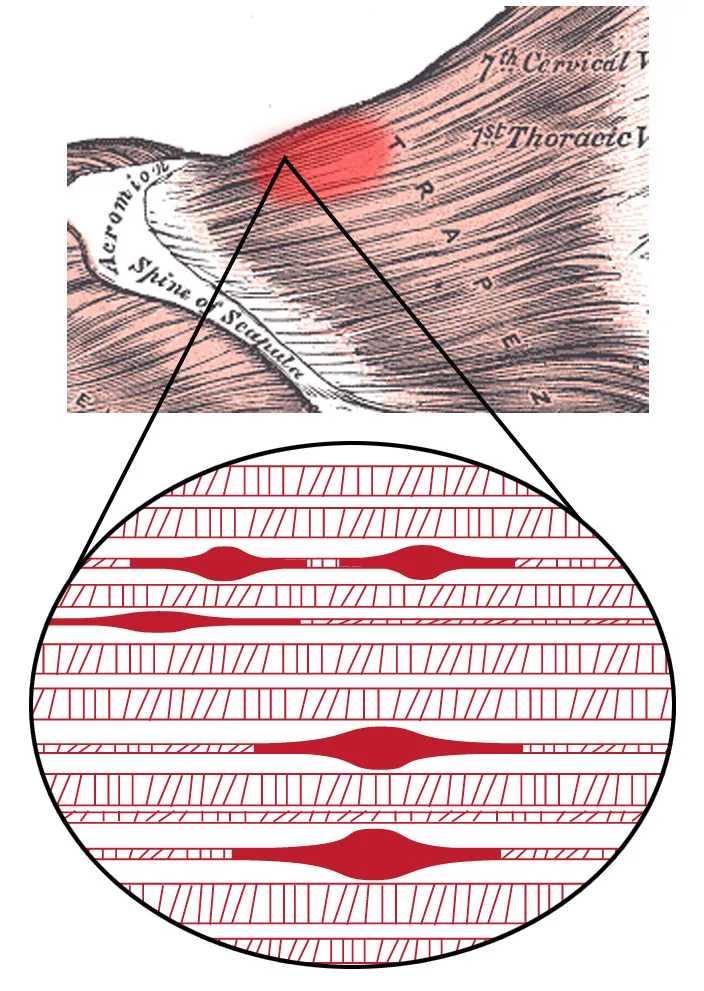 Mapa de pontos-gatilho (trigger points) de tensão miofascial no corpo